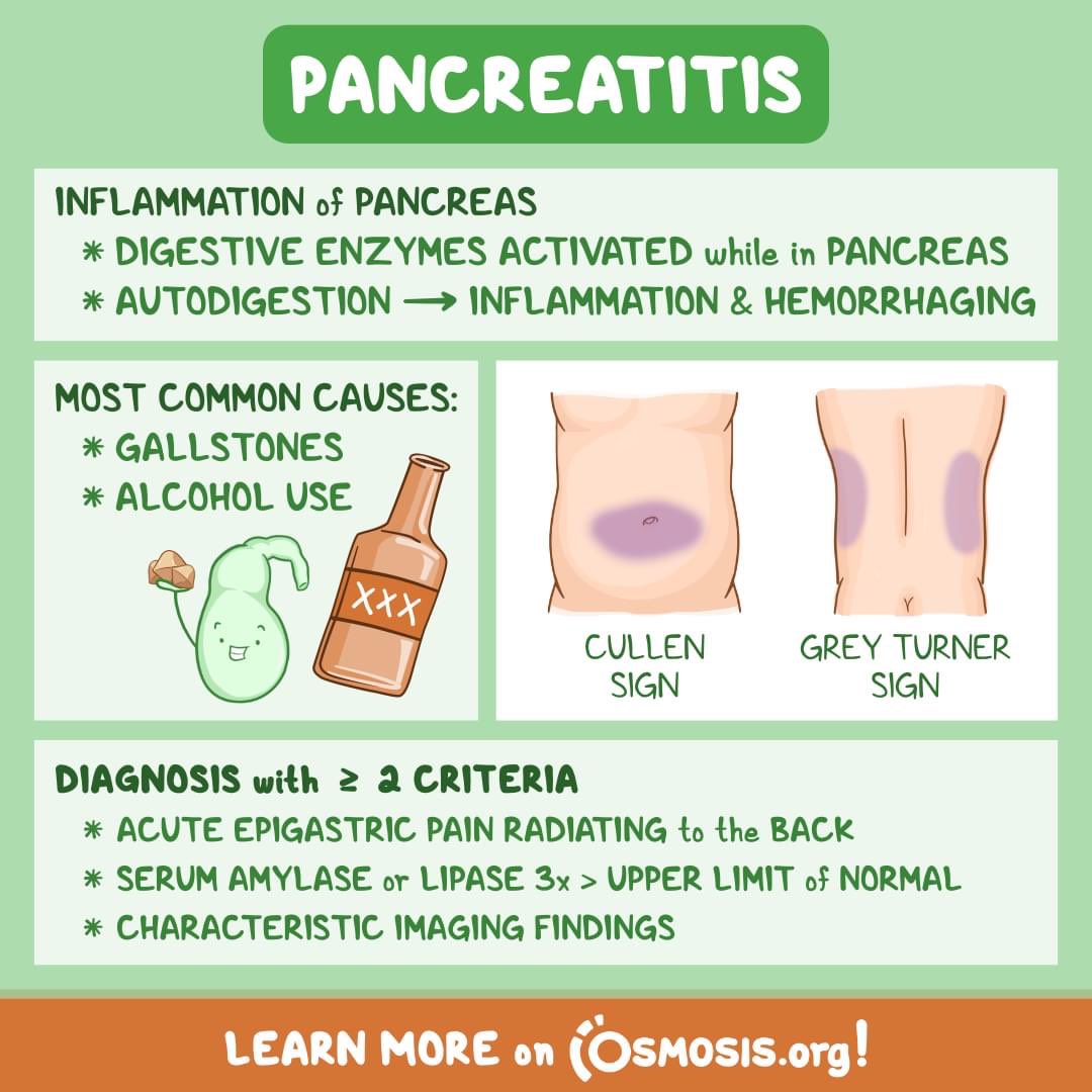 Cullen sign clinical significance