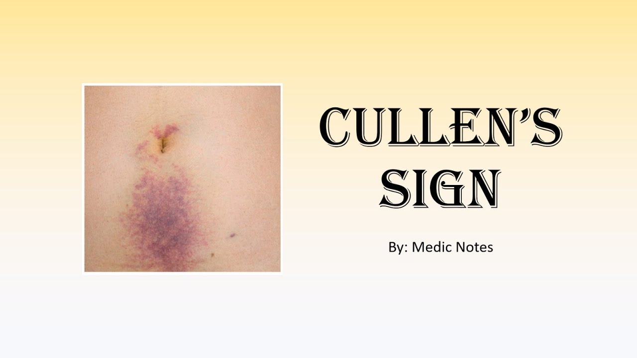 Cullen sign definition