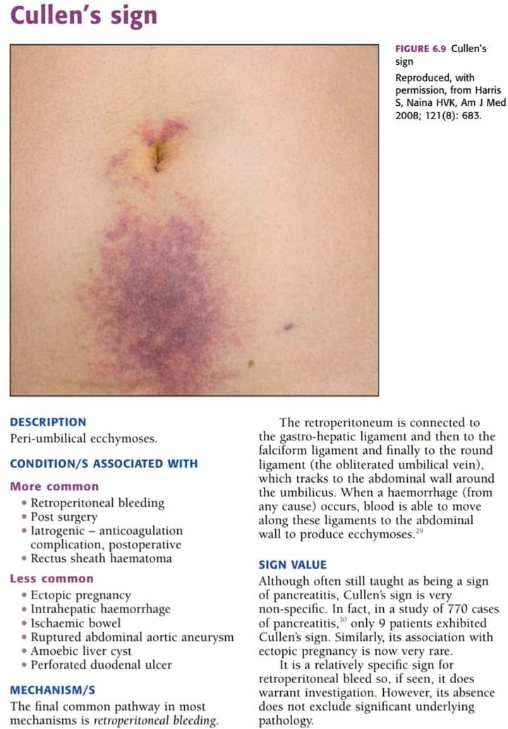 Cullen sign diagnostic relevance