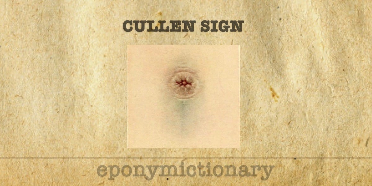 Cullen sign visual representation