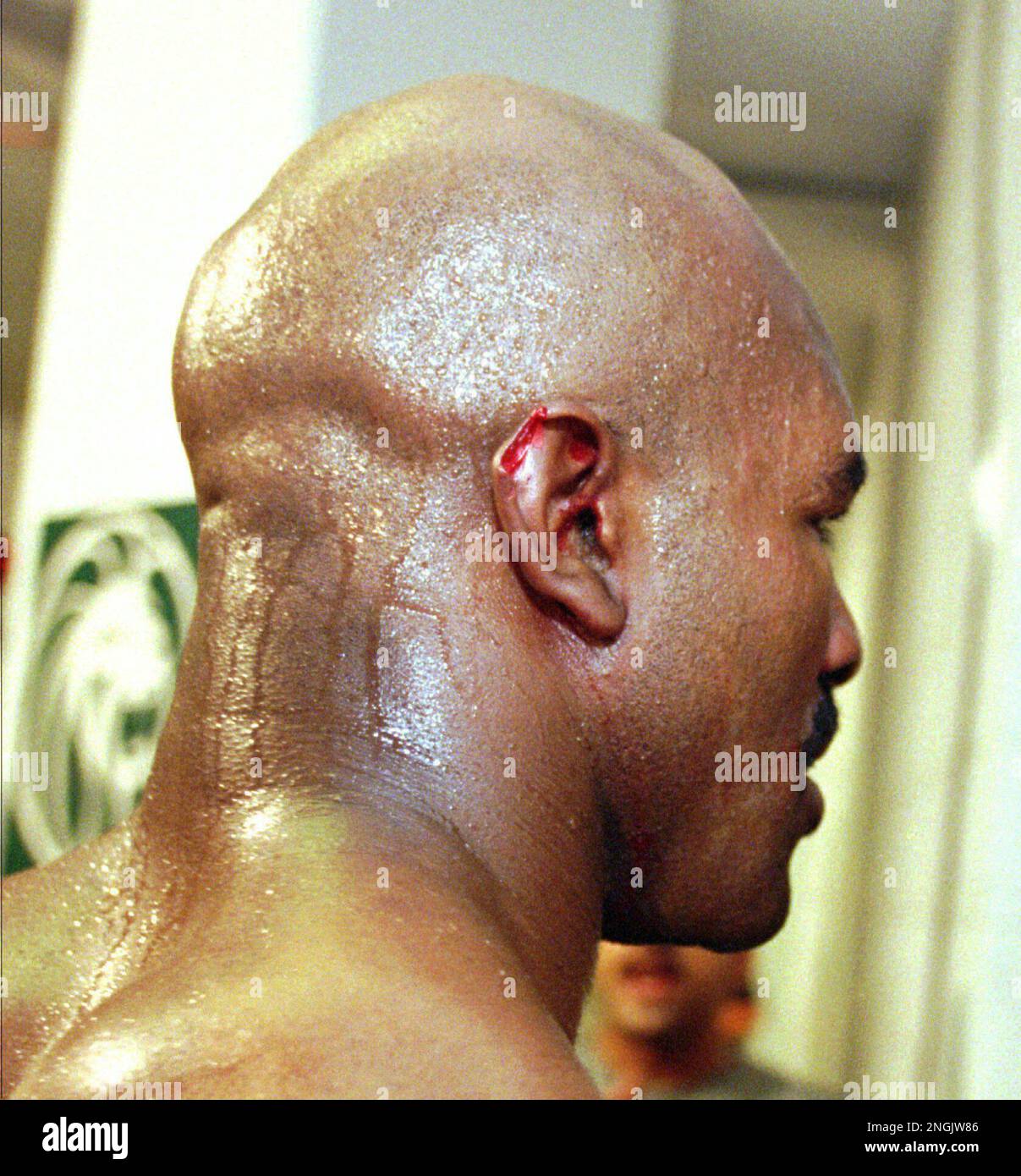 holyfield ear before and after 0014