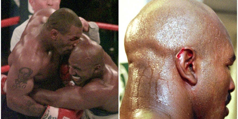 holyfield ear before and after 0016
