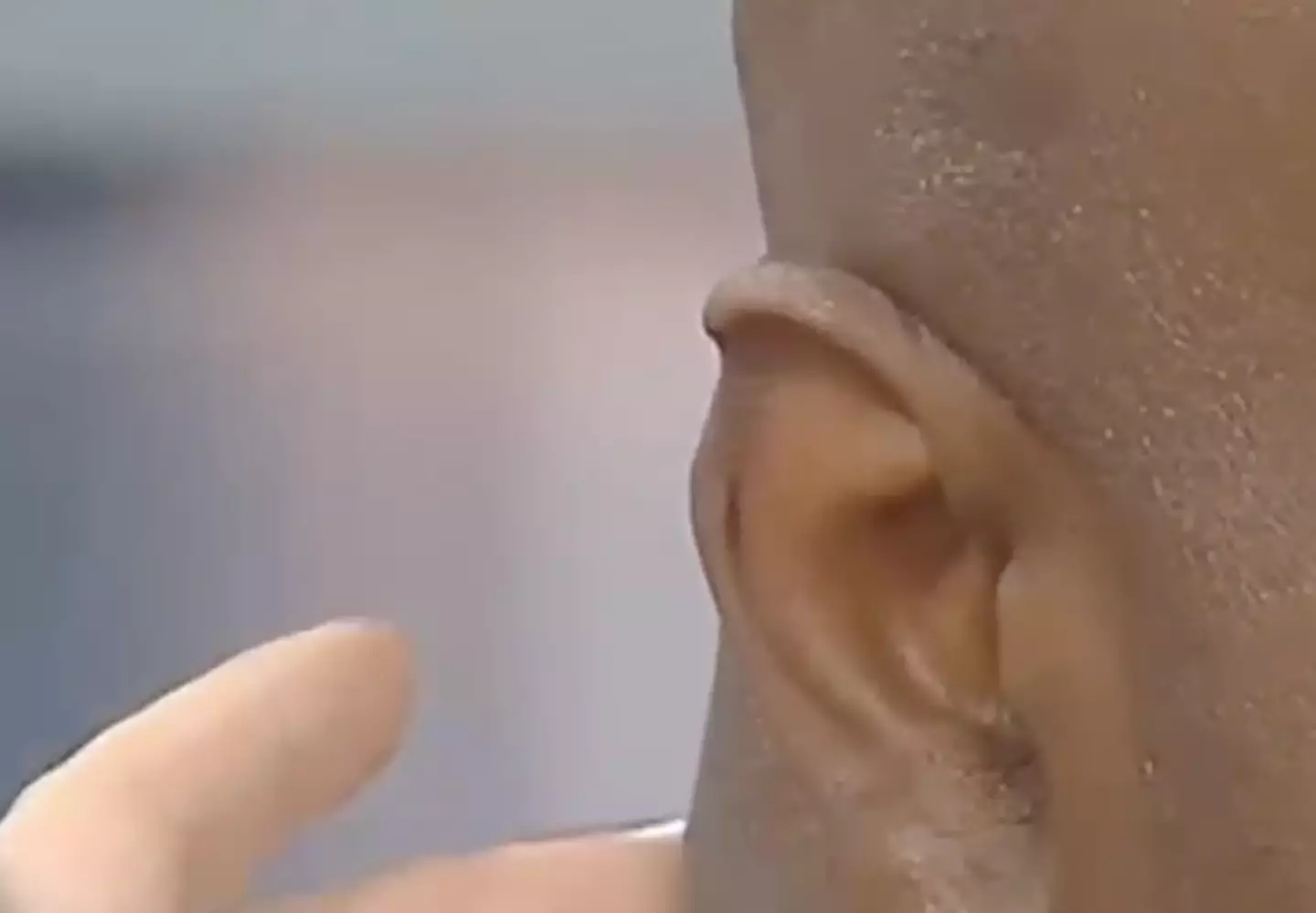 holyfield's ear after bite 0010