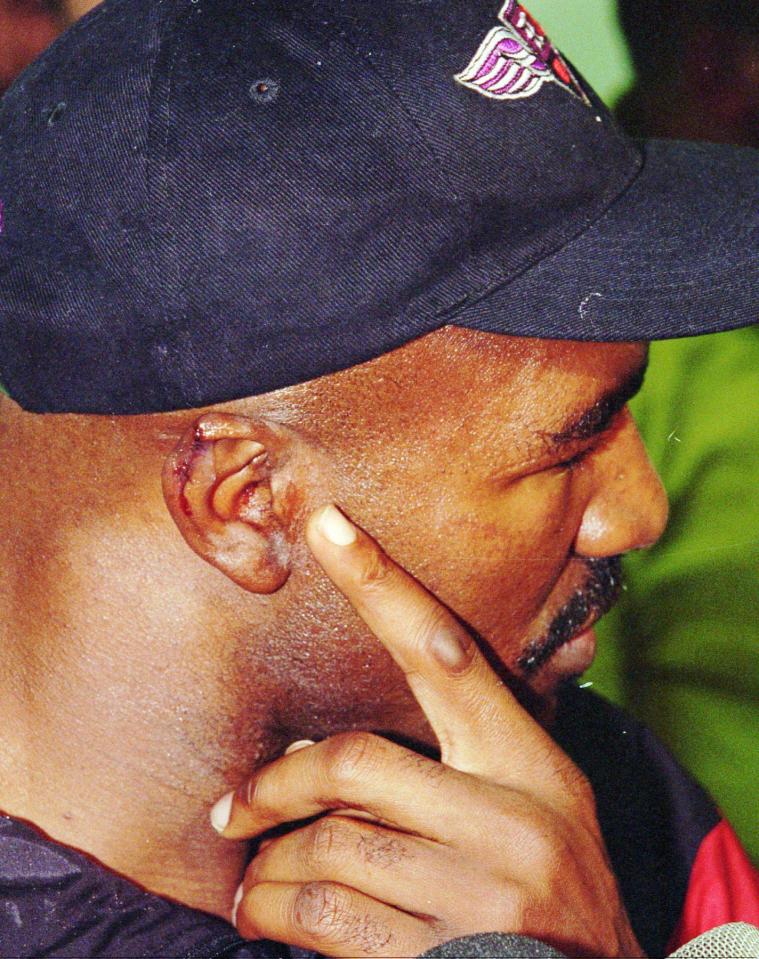 holyfield's ear after bite 0023