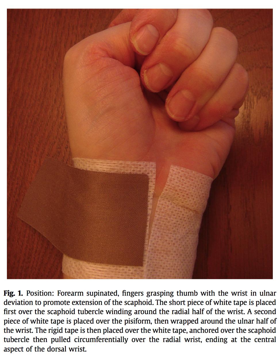 Taping Techniques for the Wrist: Rigid Tape and Kinesiology Tape